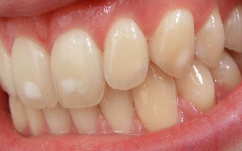 Dental_fluorosis_c)_Matthew_Ferguson