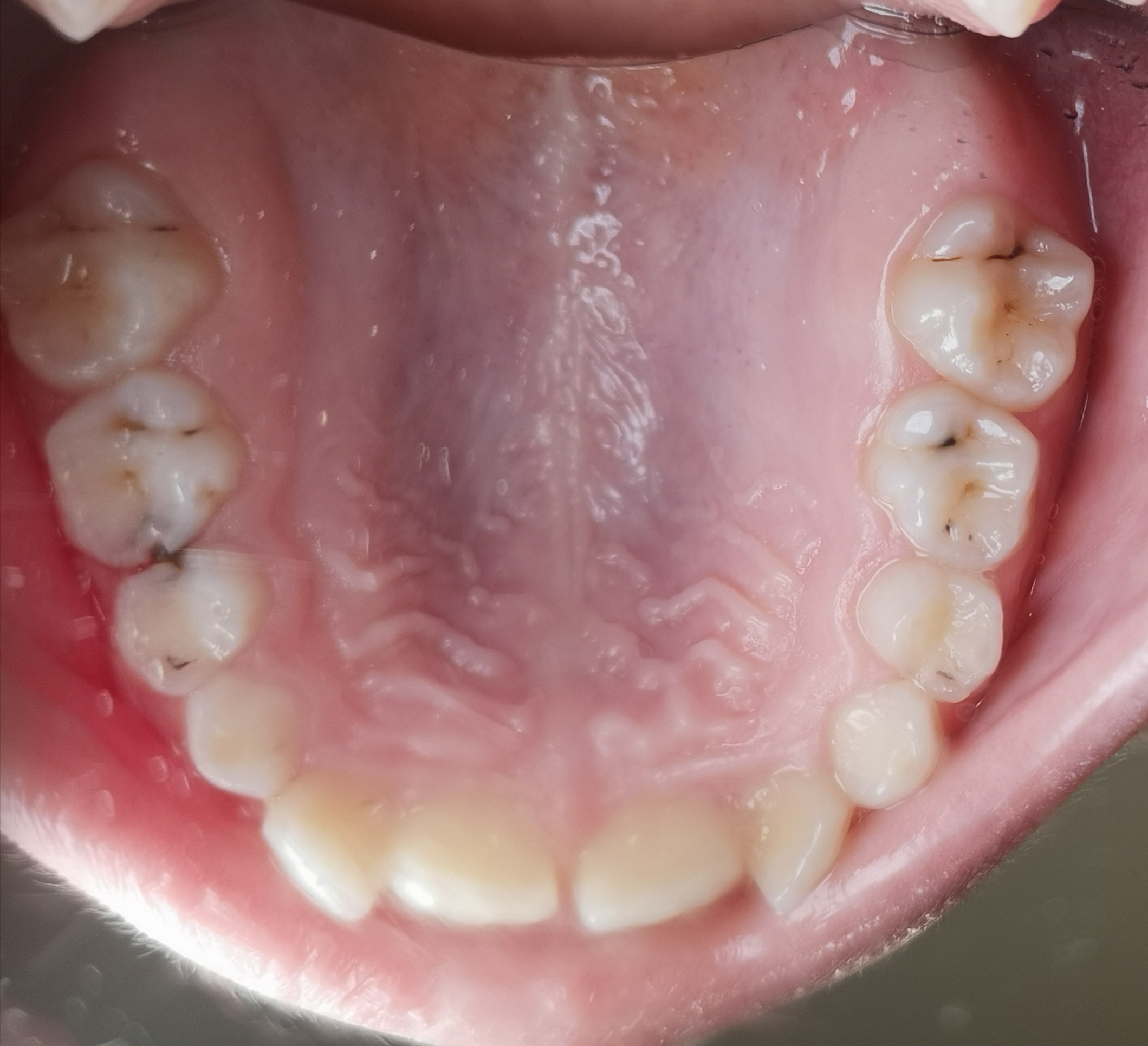 © Rammer 10jähriges Kind: Wechselgebiss mit multiplen kariösen Läsionen im Oberkiefer. Im Zahnzwischenraum regio 64 und 65 ist Karies zu erkennen. Bereits in jungen Jahren ist die Reinigung der Zahnzwischenräume unerlässlich.